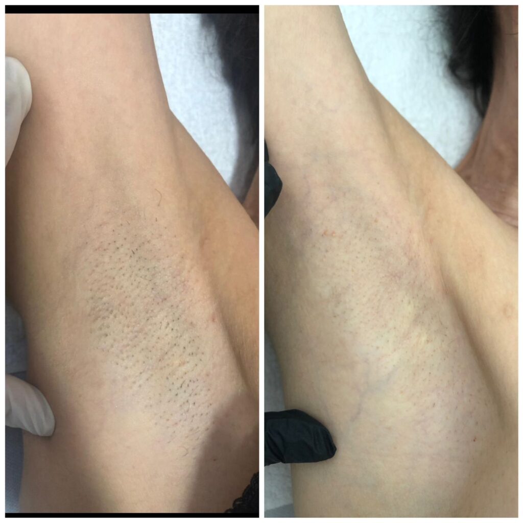 Depilação a Laser