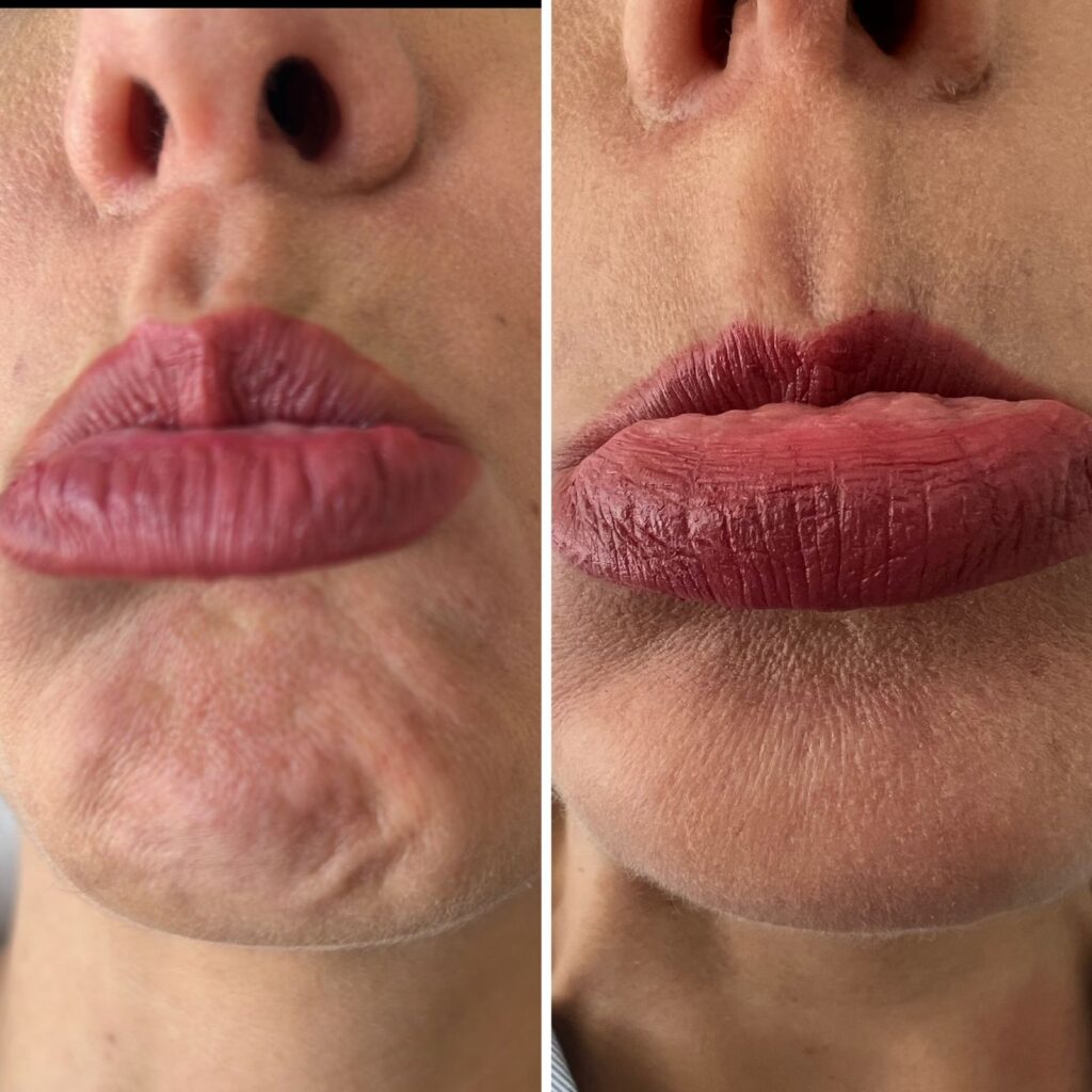 Botox