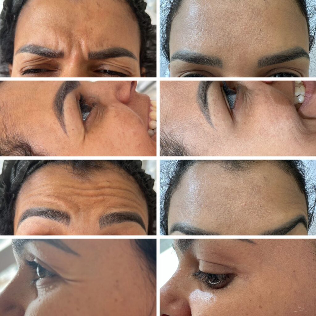 Botox