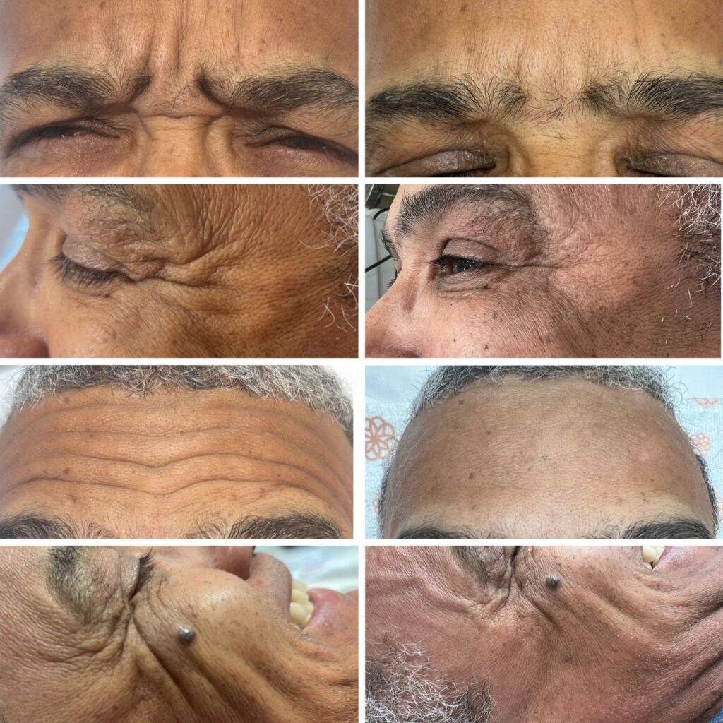 Botox