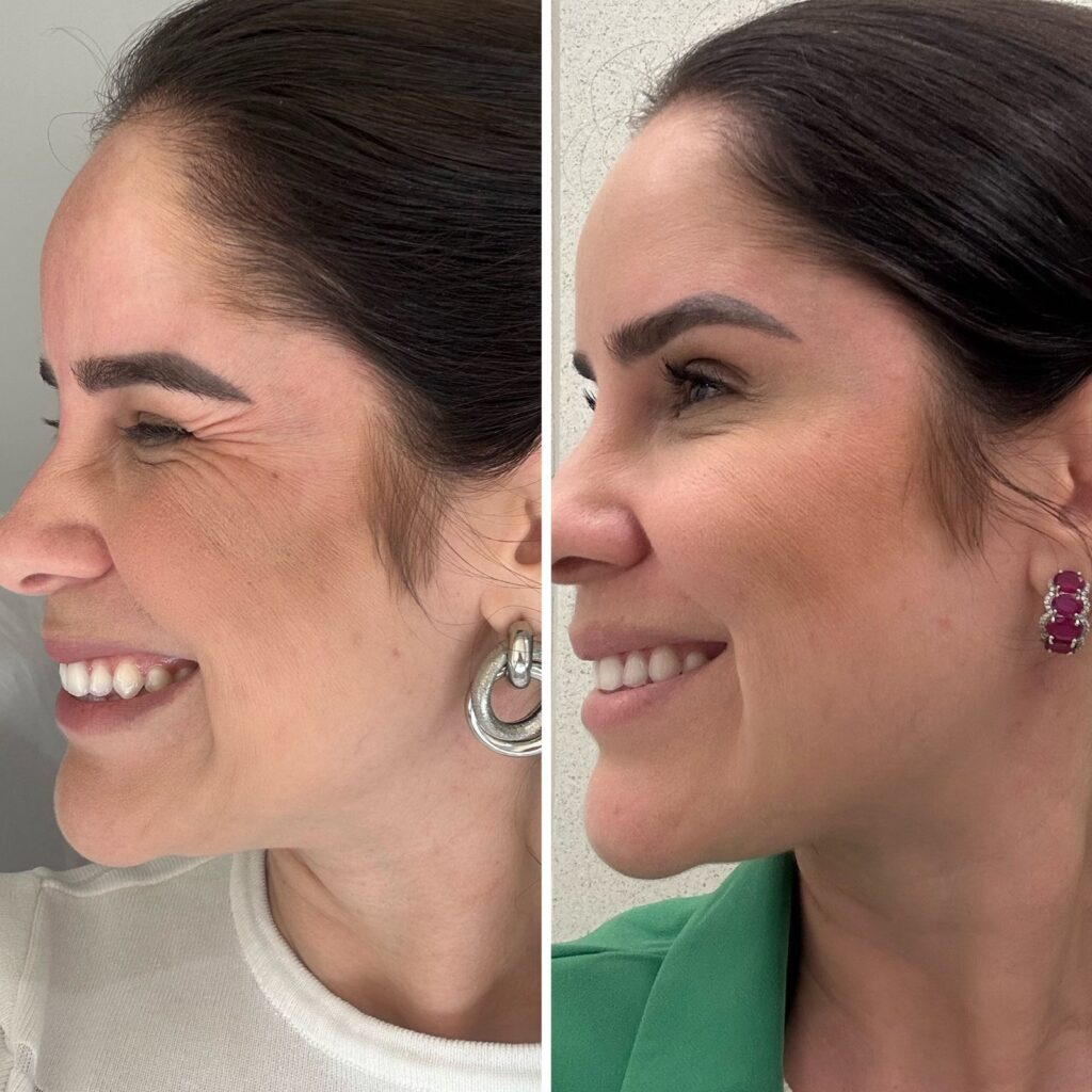 Botox