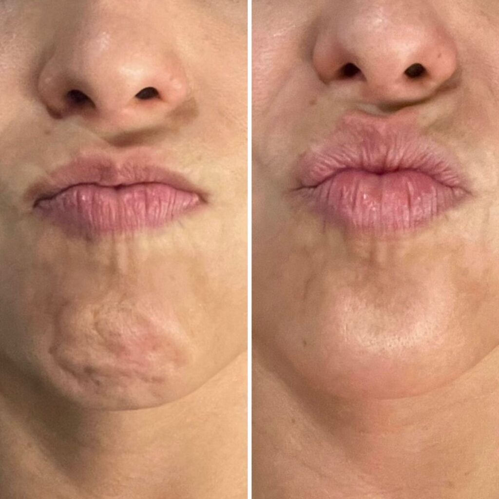 Botox